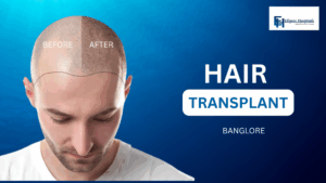 Hair Transplant Hospital in Bangalore – Eligere Hospitals