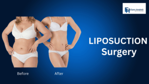 LIPOSUCTION SURGERY