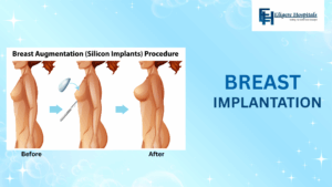 Breast Implant Surgery In Banglore