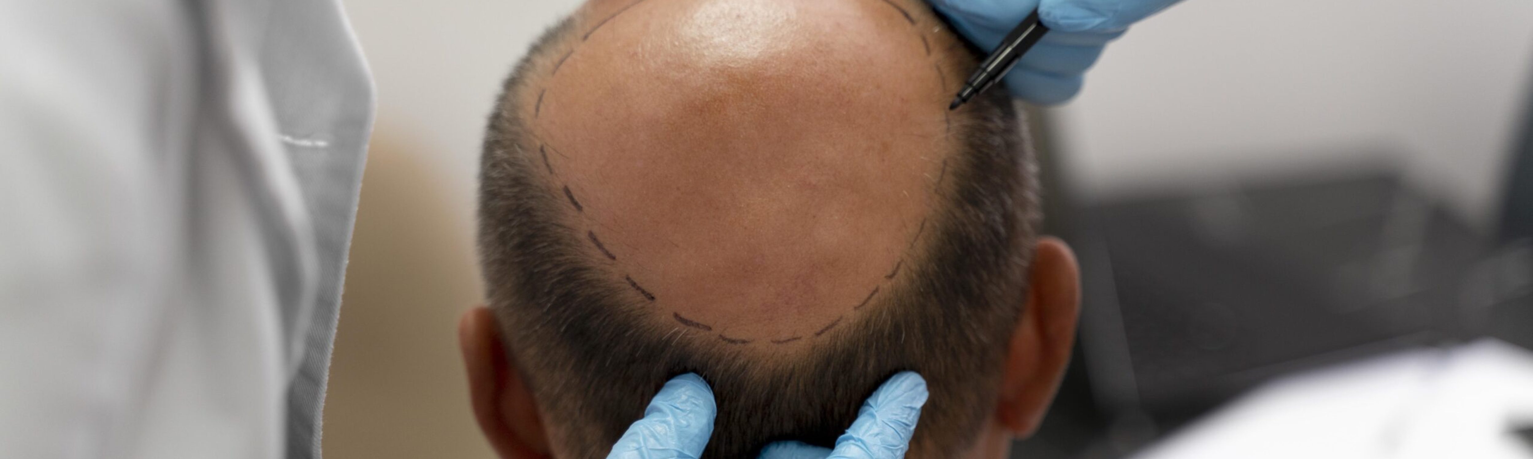 mature-man-going-through-follicular-unit-extraction-process (1)