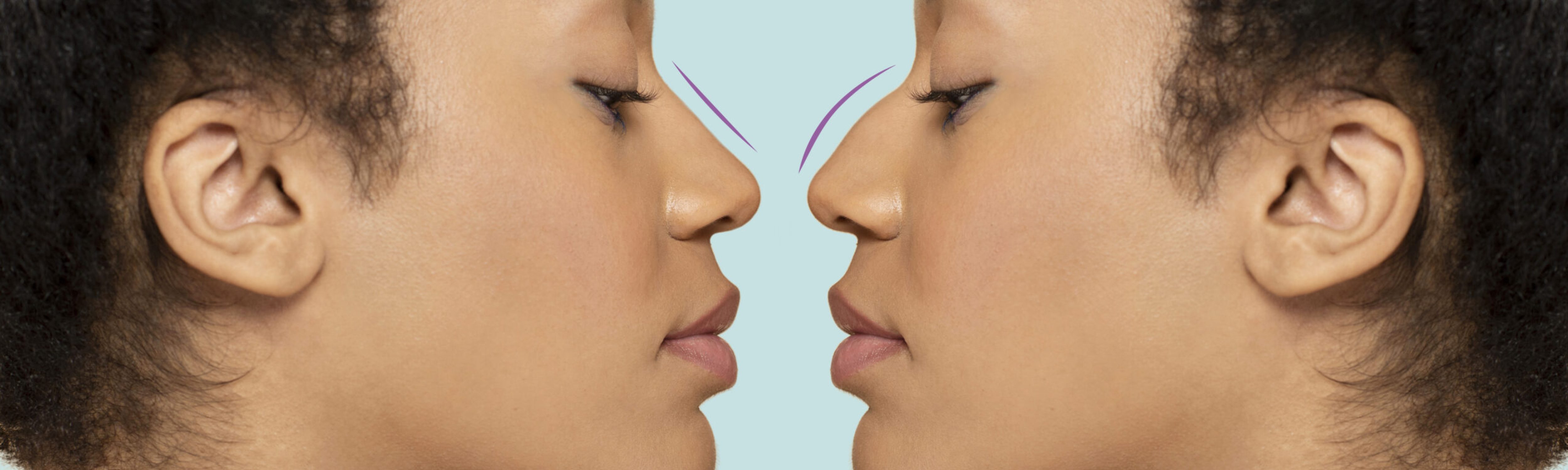 woman-getting-ready-nose-job-surgery